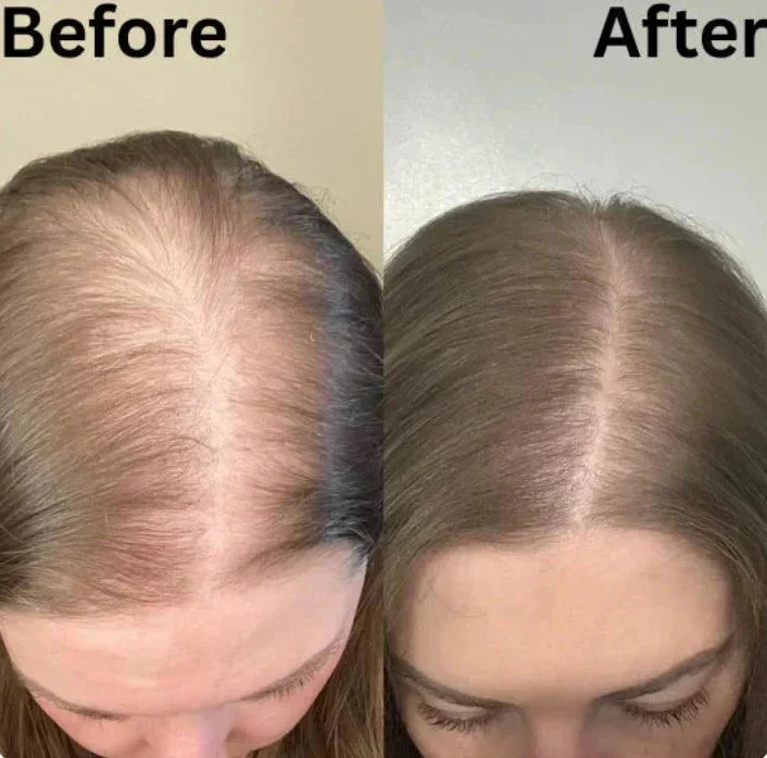 Achzvera® Rosemary Shampoo | Hair Growth & Anti-Dandruff Scalp Treatment